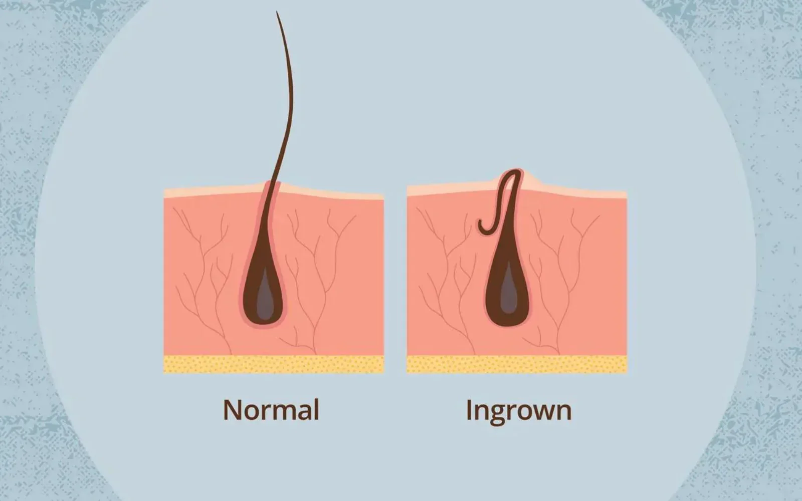What is ingrown hair? Signs, causes, and fixes